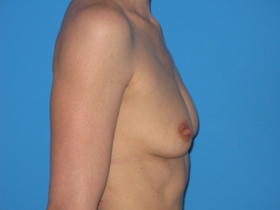 Breast Augmentation Before & After Patient #769