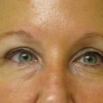 Blepharoplasty Before & After Patient #696