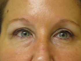 Blepharoplasty Before & After Patient #696