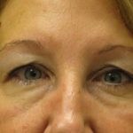 Blepharoplasty Before & After Patient #696