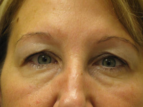 Blepharoplasty Before & After Patient #696