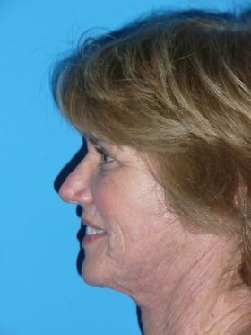 Facelift Before & After Patient #712