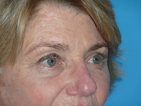 Blepharoplasty Before & After Patient #691