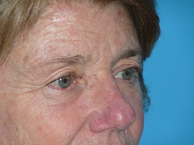 Blepharoplasty Before & After Patient #691