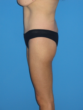 Body Lift Before & After Patient #839