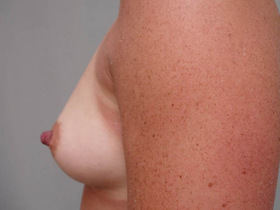 Breast Augmentation Before & After Patient #758