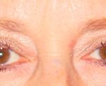 Blepharoplasty Before & After Patient #699