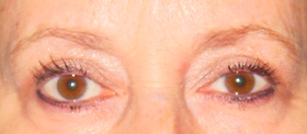 Blepharoplasty Before & After Patient #699