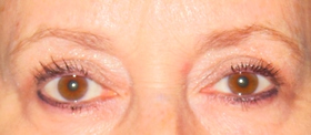 Blepharoplasty Before & After Patient #699