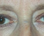 Blepharoplasty Before & After Patient #699