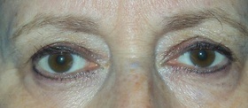 Blepharoplasty Before & After Patient #699