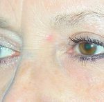 Blepharoplasty Before & After Patient #699