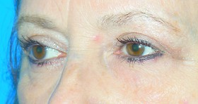 Blepharoplasty Before & After Patient #699