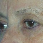 Blepharoplasty Before & After Patient #699