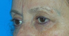 Blepharoplasty Before & After Patient #699