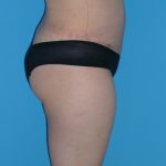 Tummy Tuck Before & After Patient #827