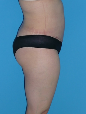 Tummy Tuck Before & After Patient #827
