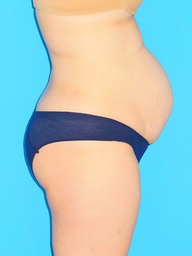 Tummy Tuck Before & After Patient #827