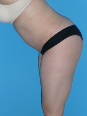 Tummy Tuck Before & After Patient #827