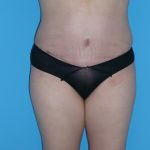 Tummy Tuck Before & After Patient #827