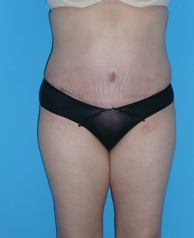 Tummy Tuck Before & After Patient #827