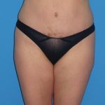 Tummy Tuck Before & After Patient #798