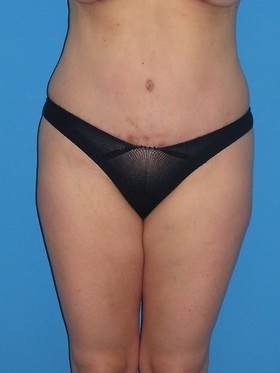 Tummy Tuck Before & After Patient #798