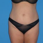 Tummy Tuck Before & After Patient #798