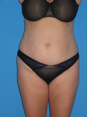 Tummy Tuck Before & After Patient #798