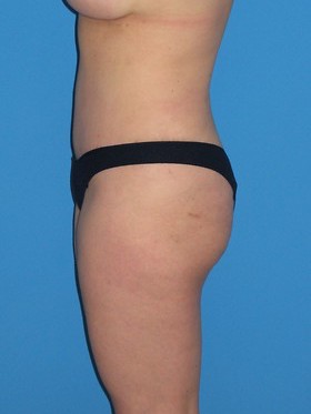 Tummy Tuck Before & After Patient #798