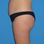 Tummy Tuck Before & After Patient #798
