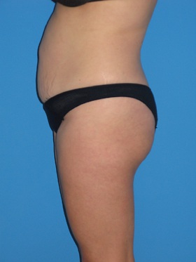 Tummy Tuck Before & After Patient #798