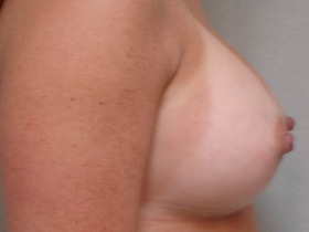 Breast Augmentation Before & After Patient #758
