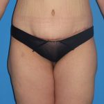 Body Lift Before & After Patient #1249