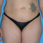 Tummy Tuck Before & After Patient #1321