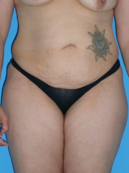 Tummy Tuck Before & After Patient #1321