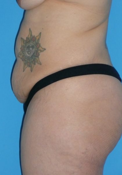 Tummy Tuck Before & After Patient #1321