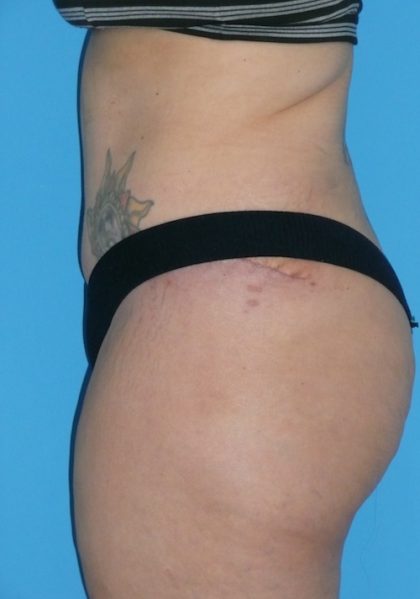 Tummy Tuck Before & After Patient #1321