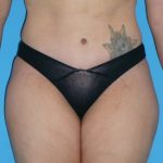 Tummy Tuck Before & After Patient #1321