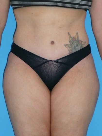 Tummy Tuck Before & After Patient #1321