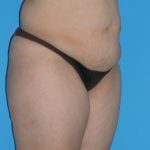 Tummy Tuck Before & After Patient #1321