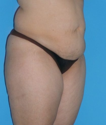 Tummy Tuck Before & After Patient #1321