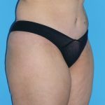 Tummy Tuck Before & After Patient #1321