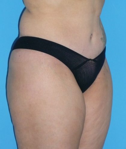 Tummy Tuck Before & After Patient #1321