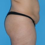 Tummy Tuck Before & After Patient #1321