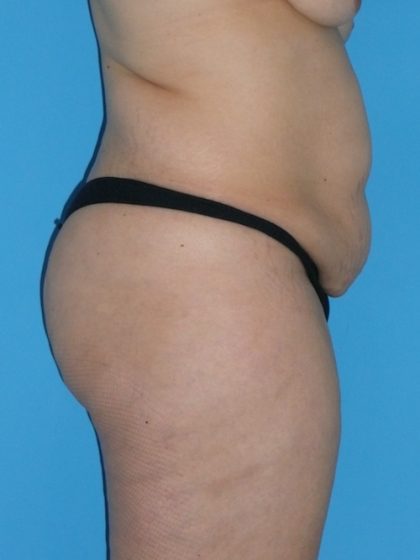 Tummy Tuck Before & After Patient #1321