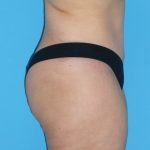 Tummy Tuck Before & After Patient #1321