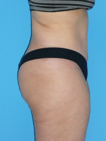 Tummy Tuck Before & After Patient #1321