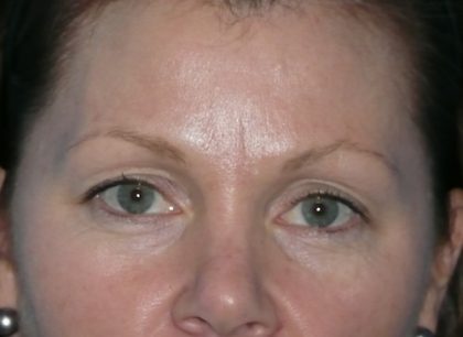 Blepharoplasty Before & After Patient #1394