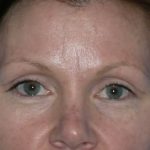 Blepharoplasty Before & After Patient #1394